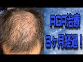 AGA治療3ヶ月経過！節目となる3ヶ月目は如何に！