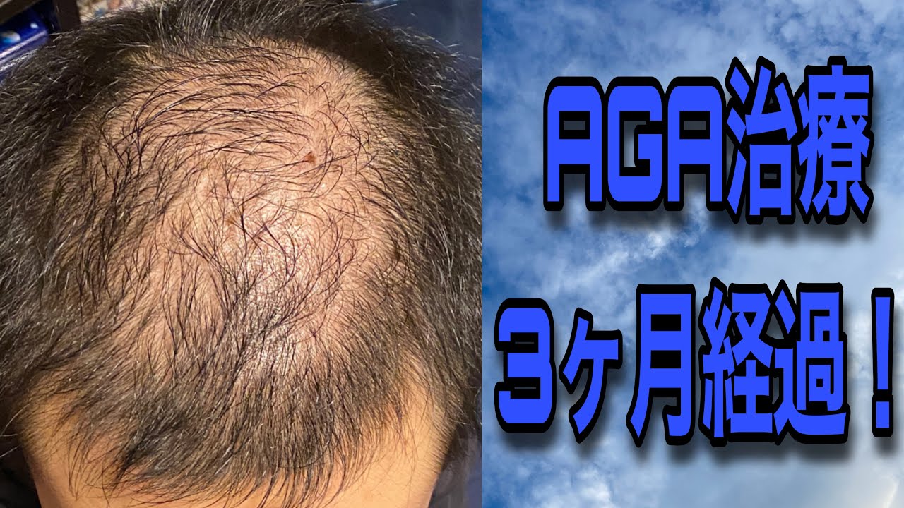 AGA治療3ヶ月経過！節目となる3ヶ月目は如何に！