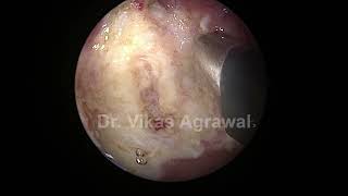 Coblation adenoidectomy in 3.5 yr child part 2