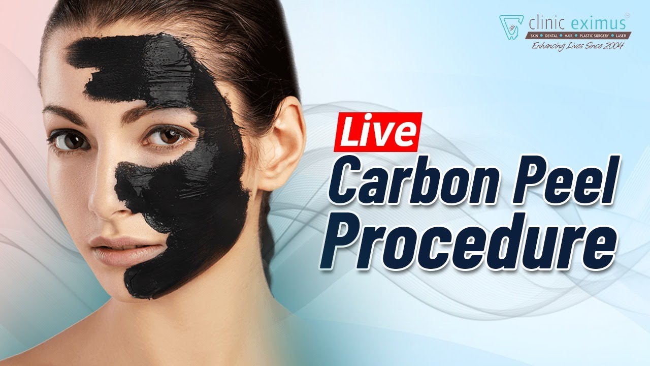 Live Procedure Carbon Peel | Carbon Peel Treatment in Hindi | Carbon Laser Treatment for Face