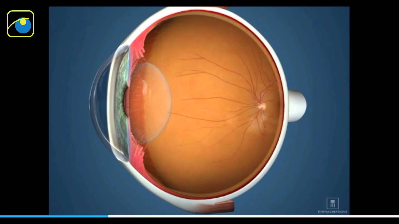 гиперметропия сетчатки