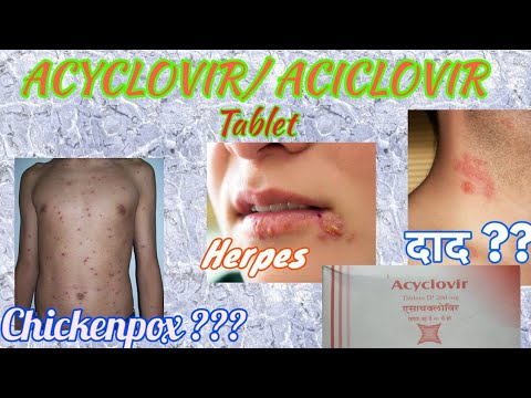 Acyclovir/ Aciclovir Tablet 200mg, 400mg, 800mg, In Hindi ALL ABOUT MEDICINE