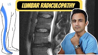 Lumbar Radiculopathy ('Sciatica'): What you need to know.