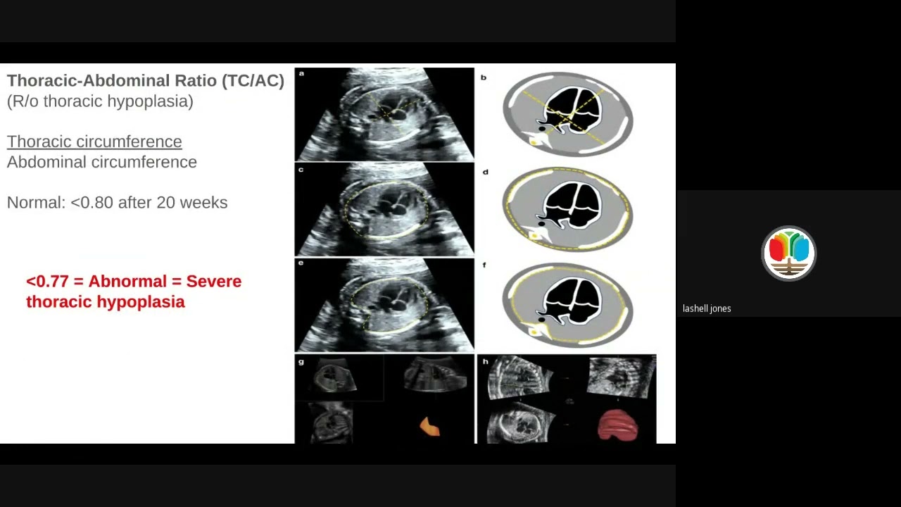 Lesson 4 Part 2: Recap of Fetal Heart Situs & Circulation