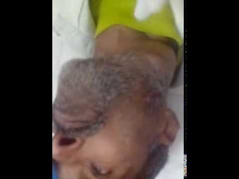 Hoarseness of voice in a patient of Cancer of Larynx spread to Lymph nodes of neck major field of study medicine