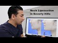 Neck Liposuction Beverly Hills - Real Results - Dr. Dass