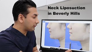 Neck Liposuction Beverly Hills - Real Results - Dr. Dass