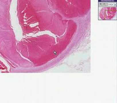 Histopathology Popliteal vein--Thrombosis