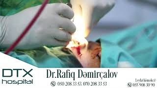 Rinoplastika - DR.Rafiq Demirchalov- Yusifzadeh Group