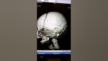 SKULL BONE FRACTURE on 3 D C.T.