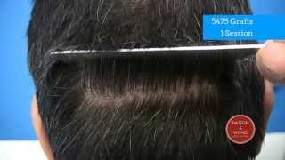 Hair Transplant Scar-Amazing-Undetectable