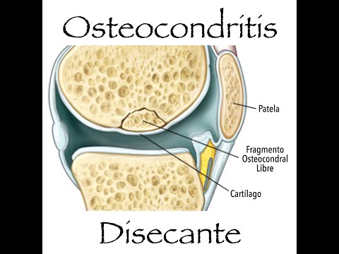 Vídeo: Osteocondritis Disecante: Síntomas, Causas, Factores De Riesgo, Tratamiento