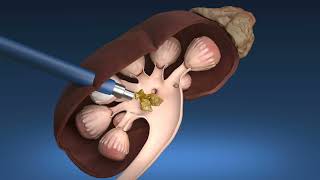 What is percutaneous nephrolithotomy (PCNL)?