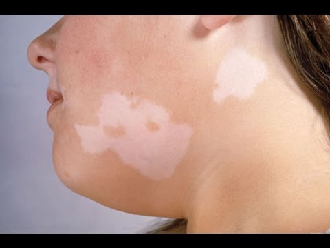 Video: Melanin Pigmenti Nasıl Azaltılır: 12 Adım (Resimlerle)