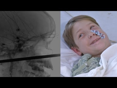 10-Year-Old Incredibly Survives Being Impaled In Face By Meat Skewer