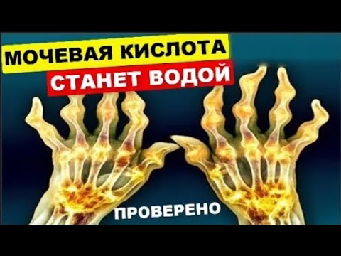 Моментально Растворяют Кристаллы МОЧЕВОЙ Кислоты ! От Подагры, Камней в Почках, Болей в Суставах