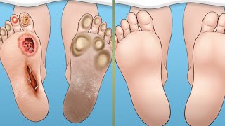 ASMR Ingrown Toenail Treat of swollen toes lig Remove excess skin toenails | Deep Cleaning Animation