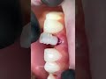 Overimplanted crown and veneer in direct technical resin