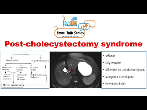 How to manage symptoms after cholecystectomy
