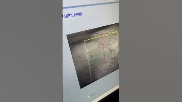 Vitreous Floaters After LASIK surgery
