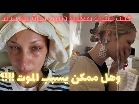بيلا حديد مصابة بمرض لايم تعرف على المرض الخطير اللي سببلها معاناة سنين بعد لسعة من حشرة القراد
