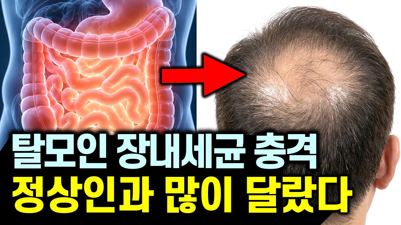 "탈모 두피염 반복된다면 매일 이것해보세요" 장이 변하면 두피, 머리카락 완치됩니다! (지루성 두피염, 탈모 치료)