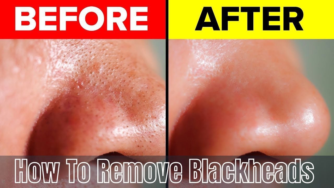 Natural Blackhead Removal Simple Steps for Clear Skin YouTube Natural Blackhead Removal Simple Steps for Clear Skin YouTube