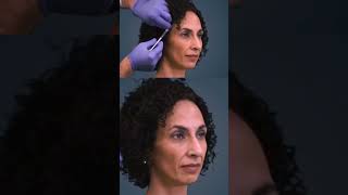 TMJ Botox Treatment | Progressive Orthodontics