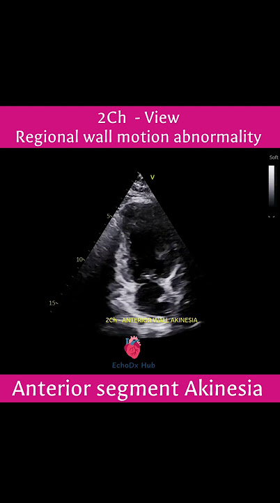 🫀 2CH View – Anterior Segment Akinesia  #echocardiography #2decho #echoeducation