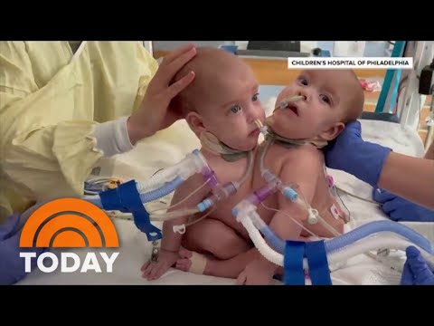 Meet The Surgeon Who Led Life-Changing Procedure To Separate Conjoined Twins