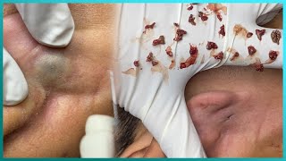 Big Cystic Acne Blackheads Extraction Blackheads Milia Whiteheads Removal Pimple Popping