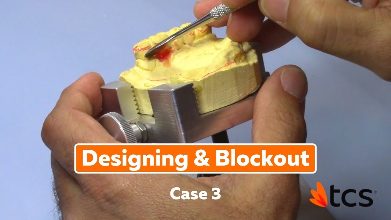 Designing & Blockout Case 3 - Why Using Karadent by TCS Is Ideal For This Case