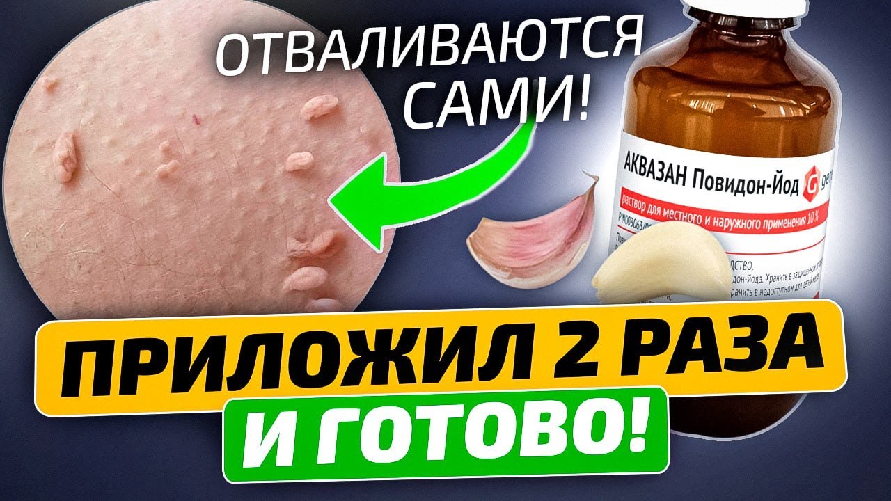 Врач дерматолог: Отпадают с корнем бородавки и папилломы, если смешать ...