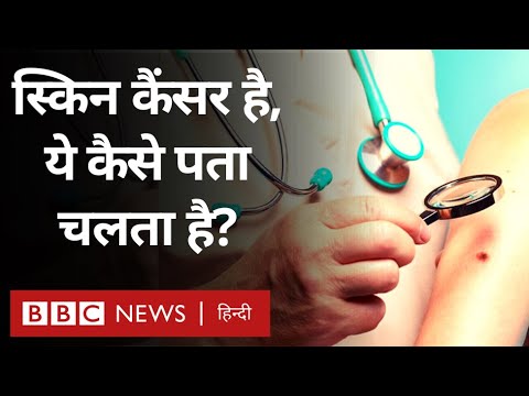 वीडियो: क्या एक बार में कई मेलेनोमा हो सकते हैं?