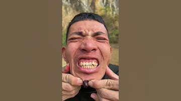 How I Cured a Bug Bite with Yogurt in the Wild | Survival Hacks