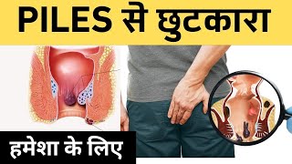 8 Amazing Treatment for piles treatment in hindi | बवासीर का जड़ से इलाज... | Ayurved shala