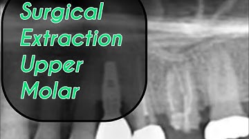 Surgical Extraction Upper Molar @drwahan 
