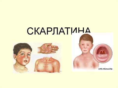 Скарлатина у детей