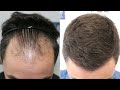 FUE Hair Transplant (2811 Grafts Norwood IV A) By Dr Juan Couto - FUEXPERT CLINIC, Madrid, Spain