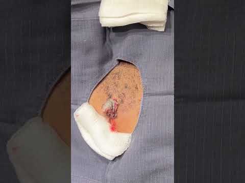 This patient almost (literally) took this cyst into his own hands... PLEASE go see your derm!