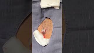 This patient almost (literally) took this cyst into his own hands... PLEASE go see your derm!