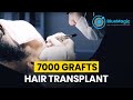 Fue sapphire hair transplant istanbul  7000 grafts hair transplant  bluemagic group international