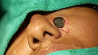Giant Facial Mole Removal Permanently - Surgical Method