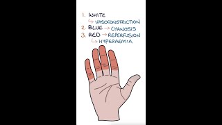 Raynaud's Disease #medicine #rheumatology