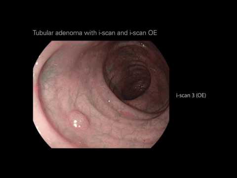 Video: Hvad er et tubulært adenom?