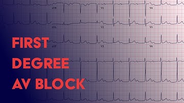 First Degree AV Block -  EKG (ECG) Interpretation