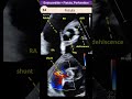 Endocarditis - Perforation / Fistula