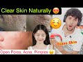 Get Clear Skin Naturally | Remove Pimples, Dark Spots &amp; Open Pores, Men Grooming tips, Men Skincare,