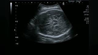 How to perform Middle cerebral artery (MCA) Doppler in fetus