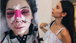 BURUN ESTETİĞİ HAKKINDA | Burun Ameliyatı Fotoğraflarıma Bakıyorum!